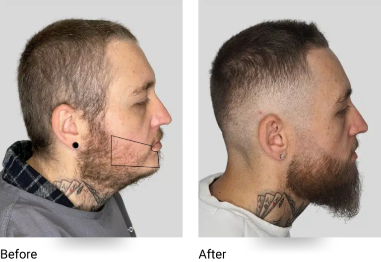 Moustache and Beard Transplant Sydney Hair Doctors