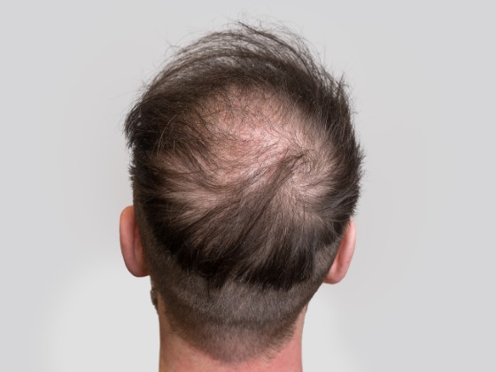 Expert Alopecia Treatment in Sydney | Hair Doctors