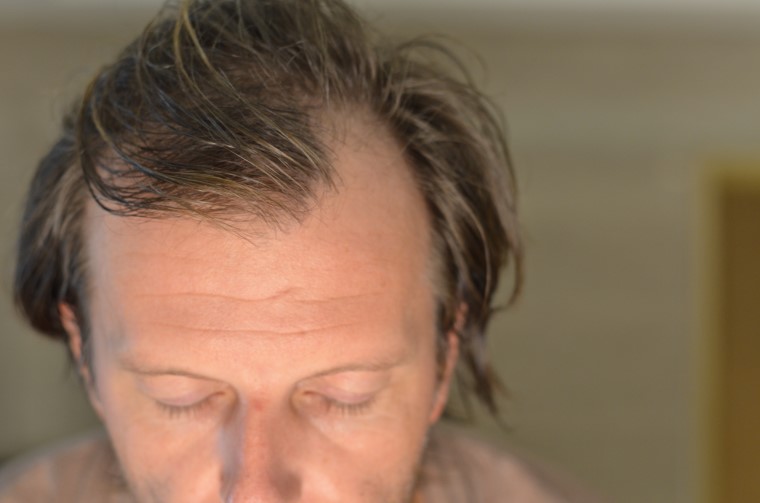 Quitting Smoking | Medical Hair Growth Treatments | FUE Hair Transplant | Hair Loss Clinic | Hair Doctors Melbourne & Sydney
