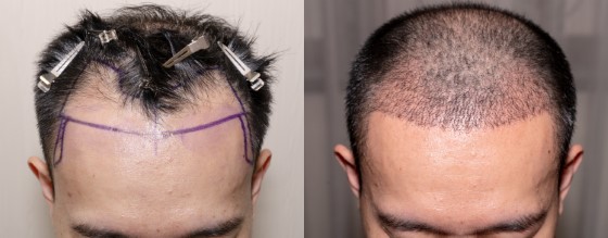 forehead reduction surgery Sydney - Hair Doctors