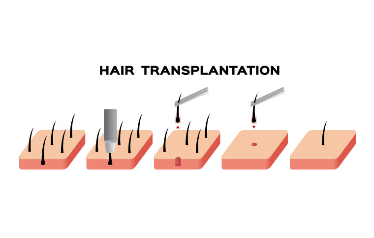 fue hair transplant sydney - Hair Doctors
