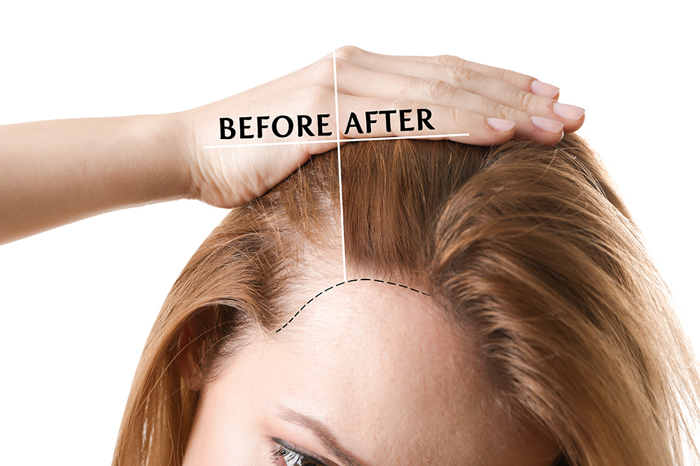 how effective is a hair transplant