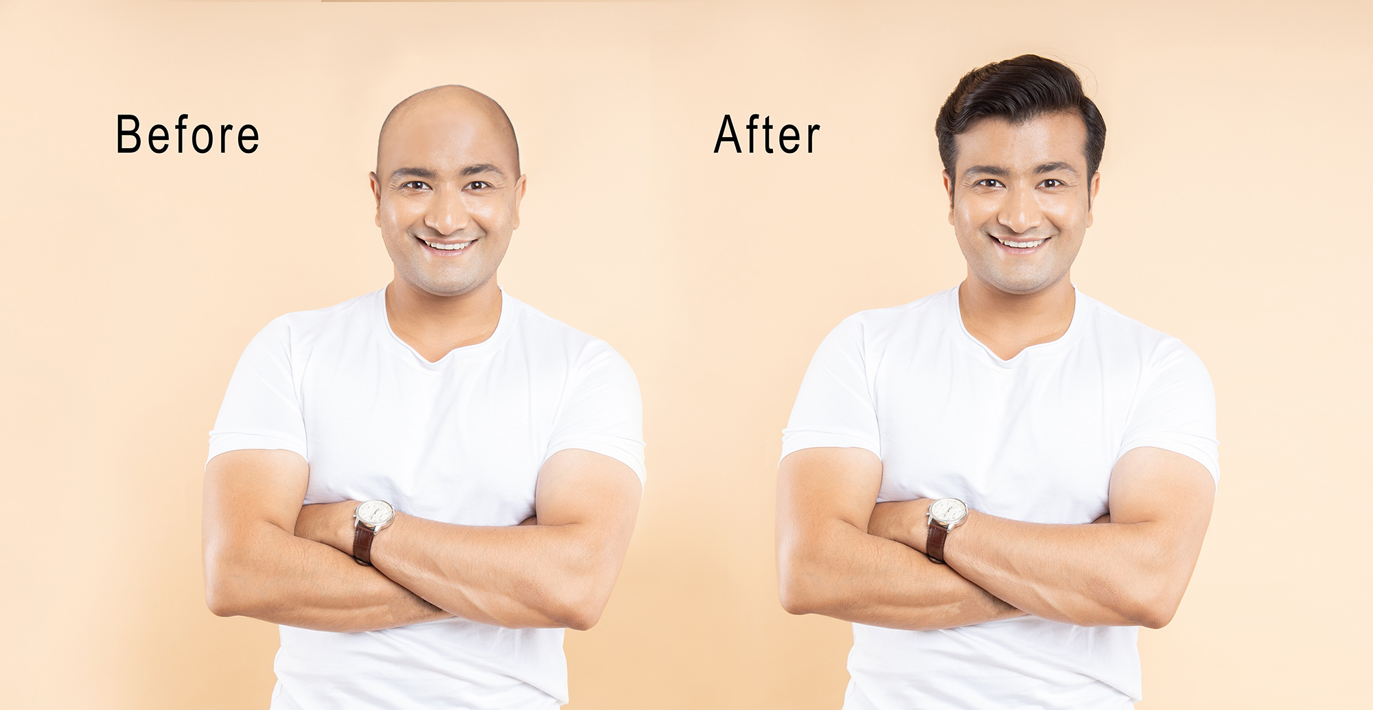How Effective Are Hair Transplants? - Hair Doctors