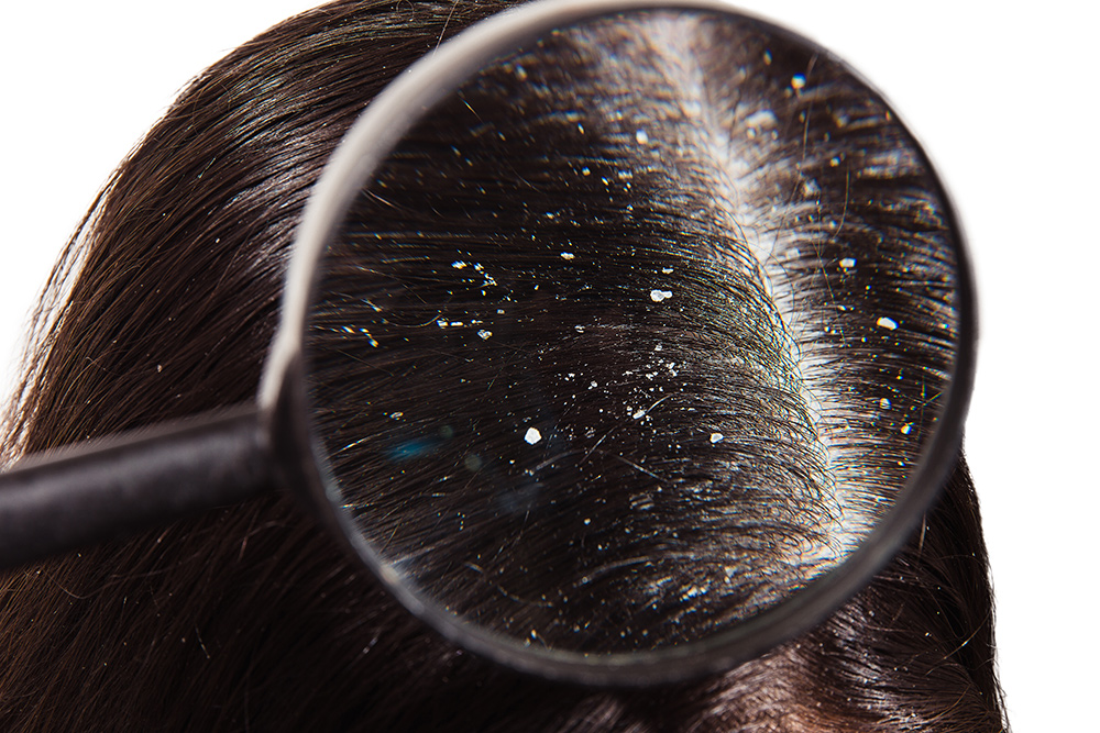 does dandruff cause hair loss