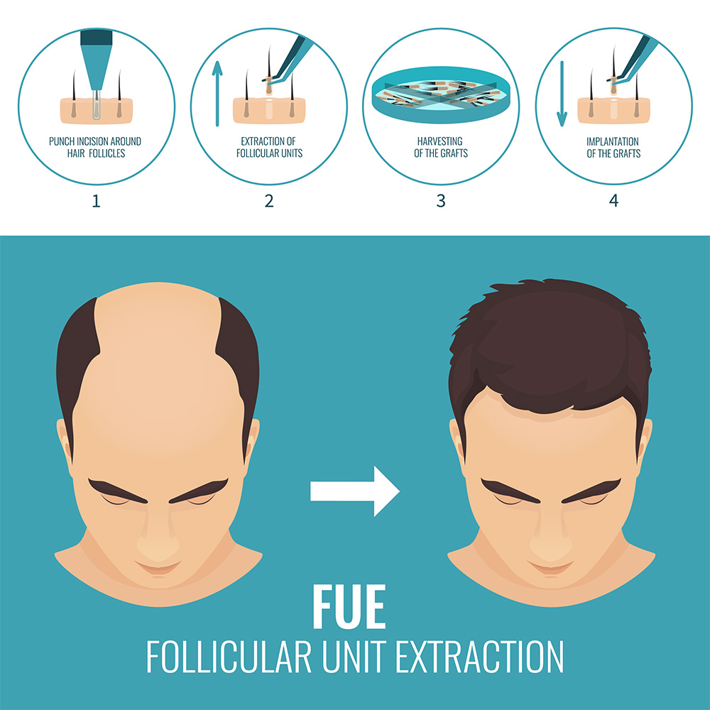 FUE Hair Transplant | Hair Restoration | Is Hair Transplant Permanent | Hair Doctors Sydney