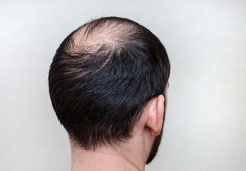 Permanent Solution to Hair Thinning | Post Hair Transplant Care | Hair Transplant Surgery | Hair Restoration Surgery | Hair Doctors Sydney