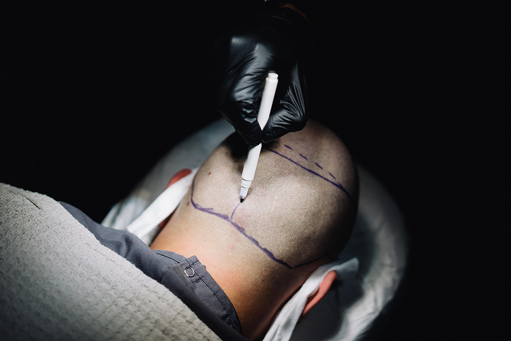 Follicular Unit Extraction FUE | Androgenetic Alopecia | Hair Transplant Surgery | Hair Doctors Sydney