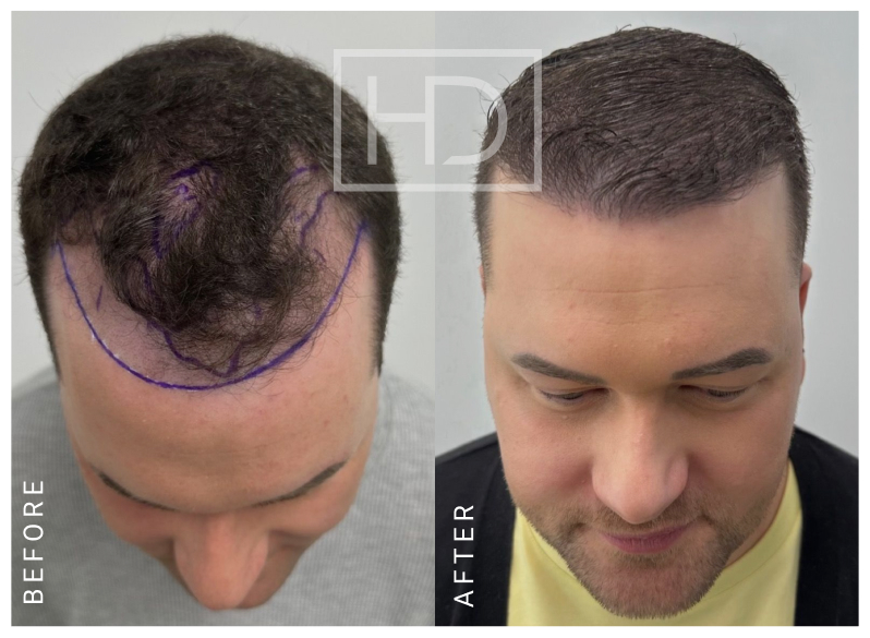 Doctor Hair Transplant Before & After