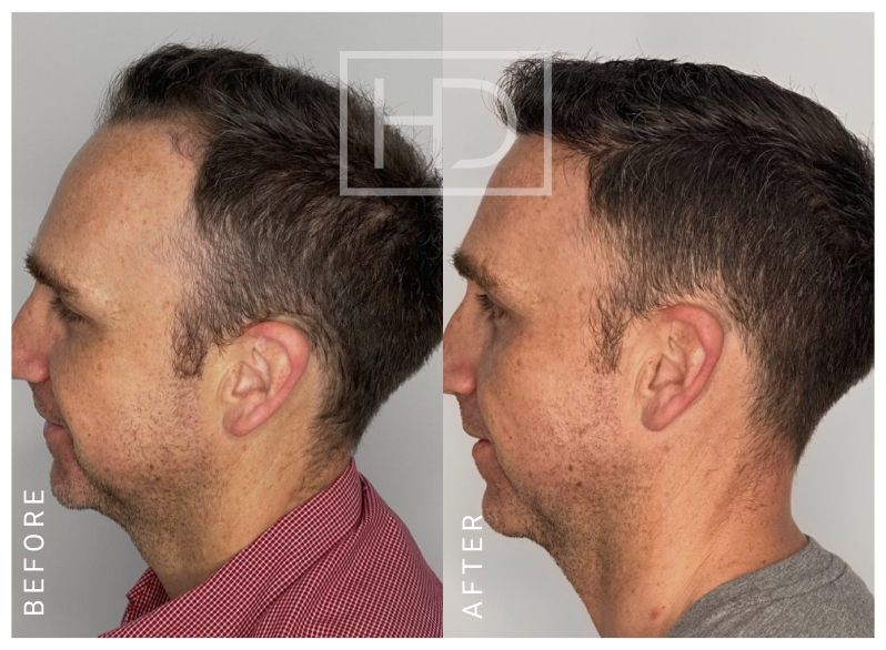 Doctor Hair Transplant Before & After