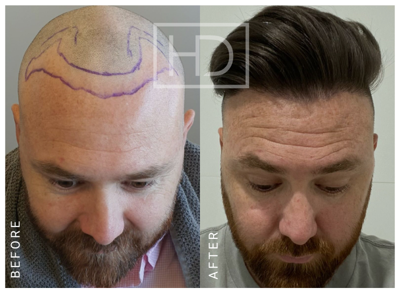 Doctor Hair Transplant Before & After