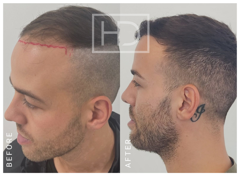 Doctor Hair Transplant Before & After