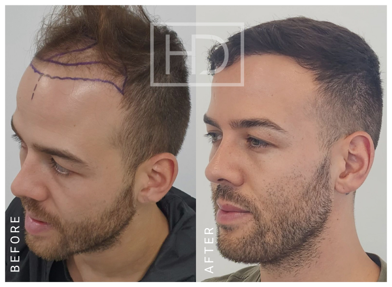 Doctor Hair Transplant Before & After