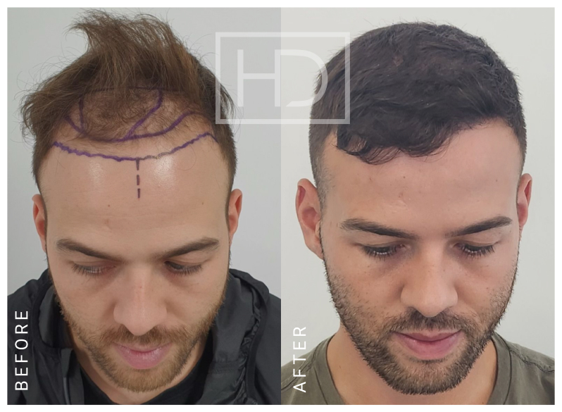 Doctor Hair Transplant