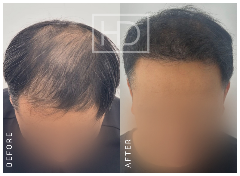 Nurse Hair Transplant
