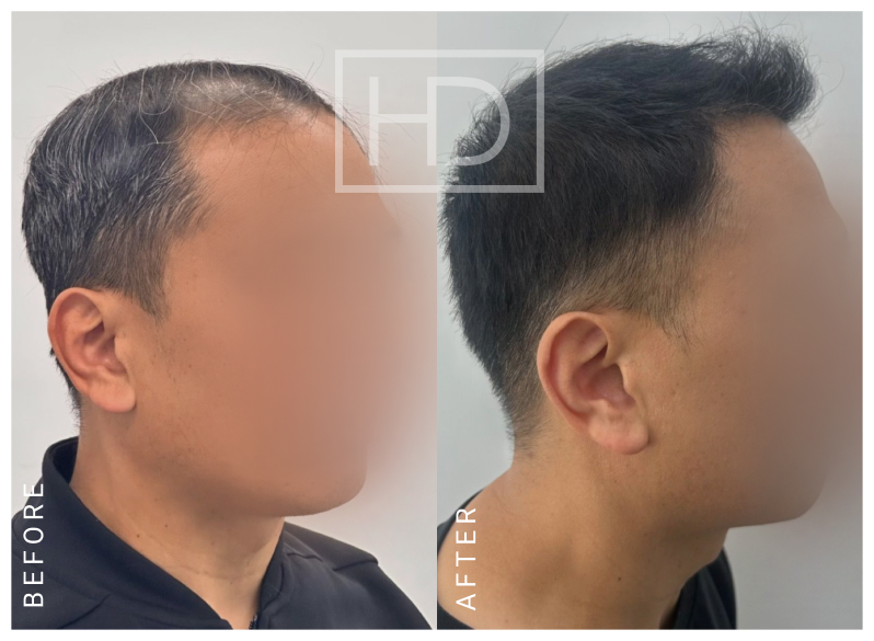 Nurse Hair Transplant