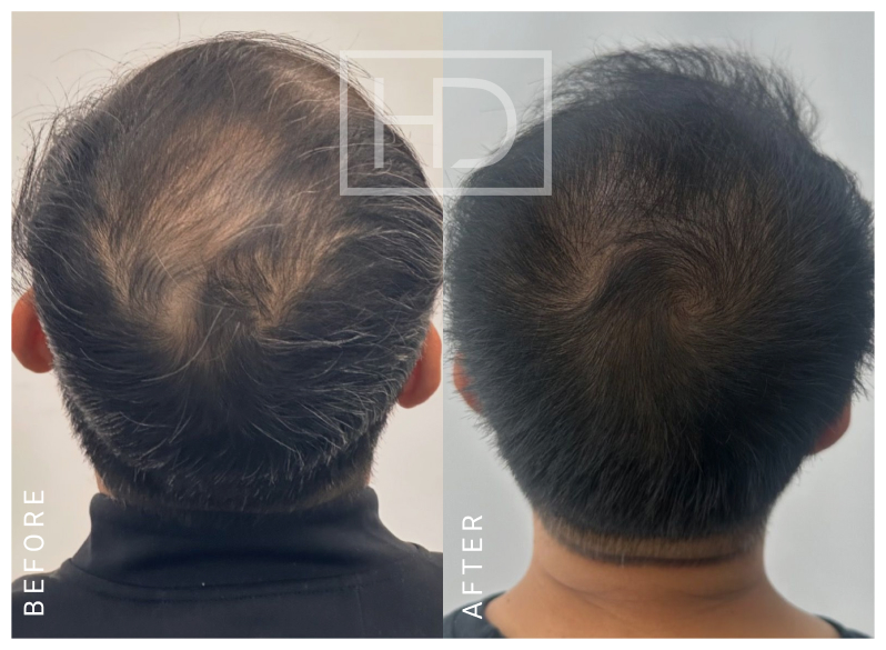 Nurse Hair Transplant