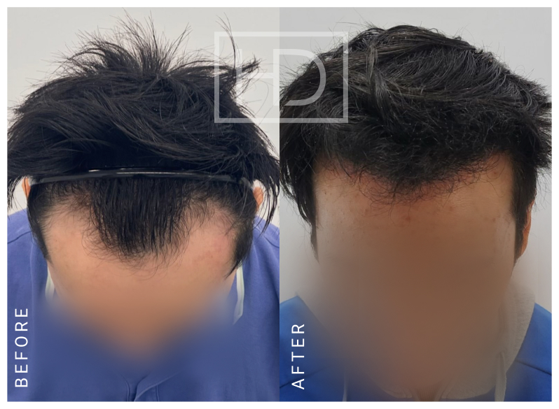 Nurse Hair Transplant