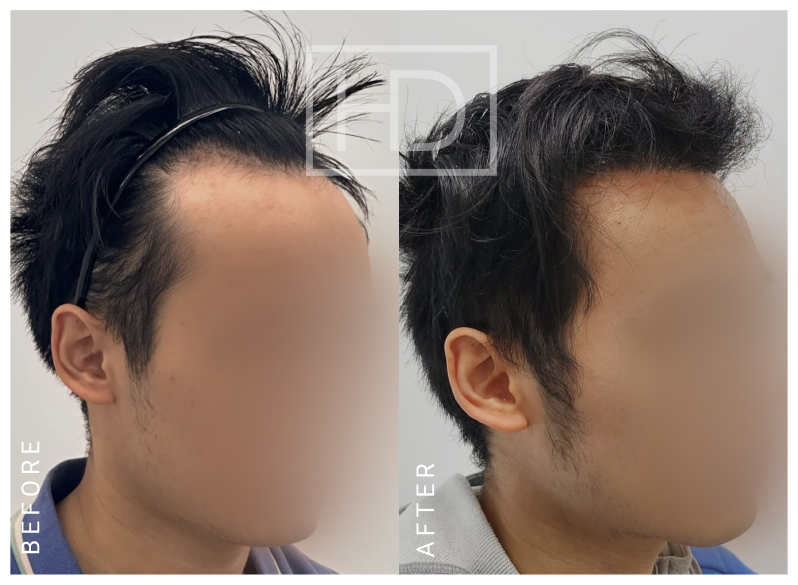 Nurse Hair Transplant