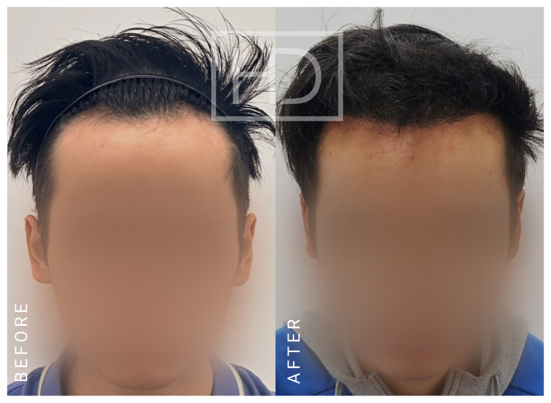 Nurse Hair Transplant