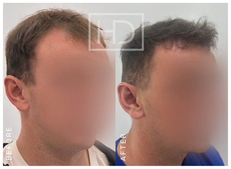 Nurse Hair Transplant
