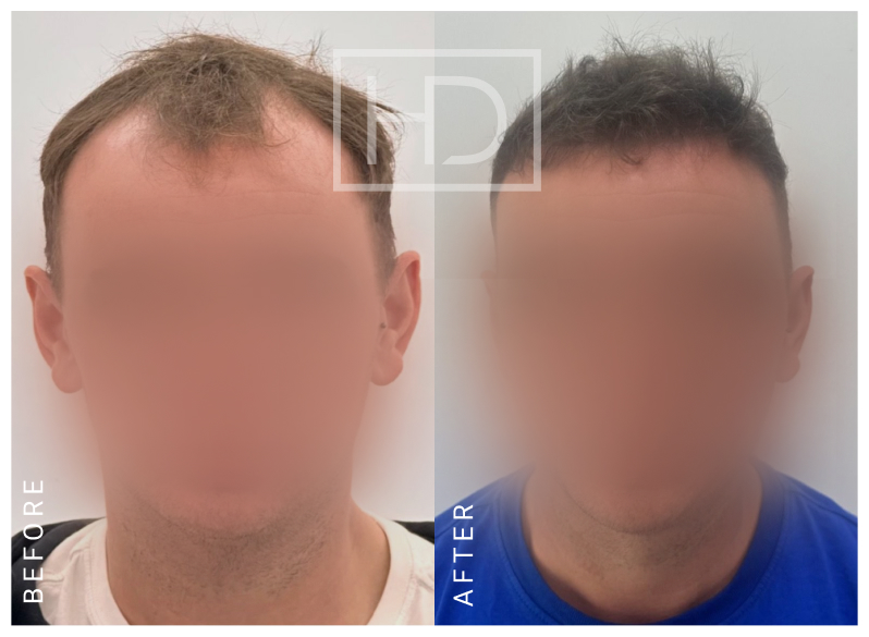 Nurse Hair Transplant