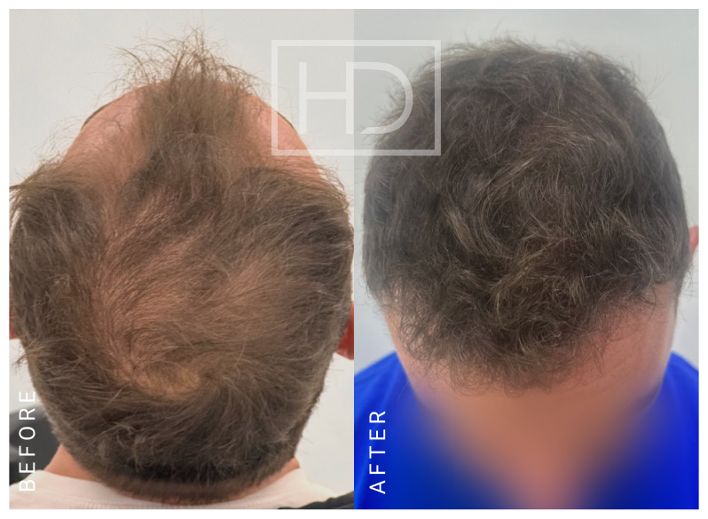 Nurse Hair Transplant