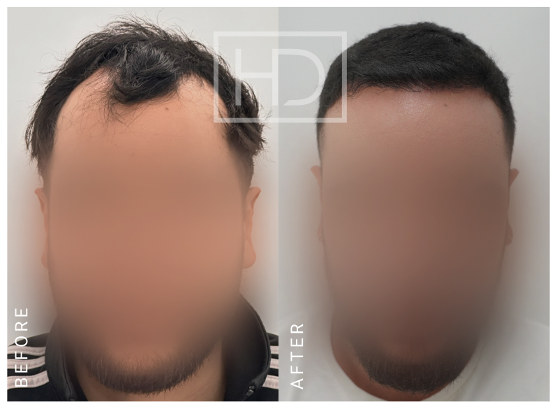Nurse Hair Transplant