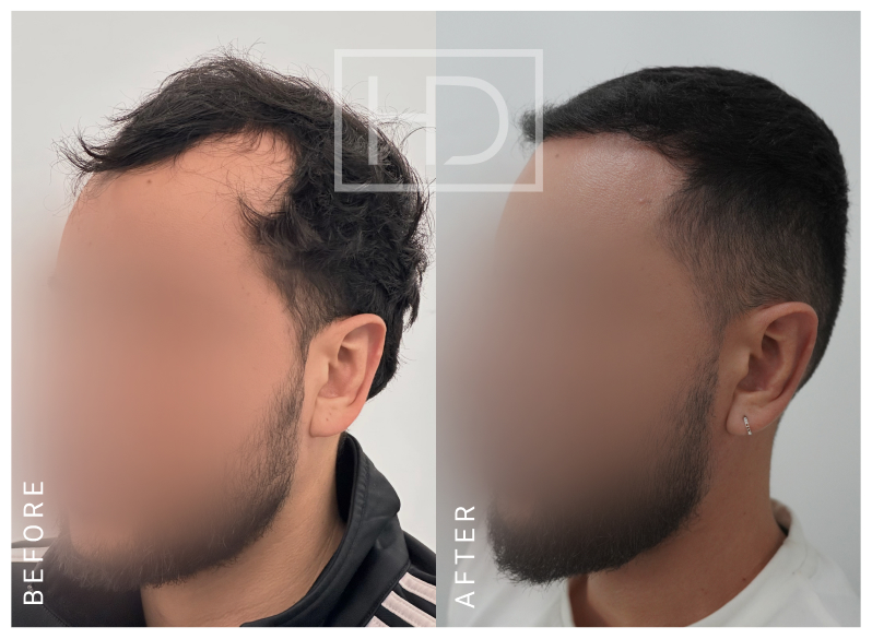 Nurse Hair Transplant