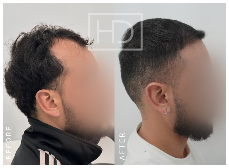 Nurse Hair Transplant