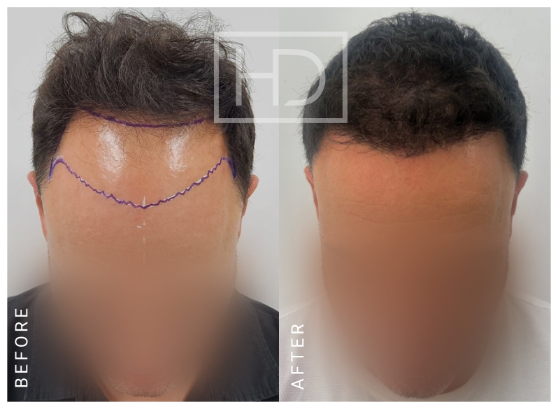 Nurse Hair Transplant