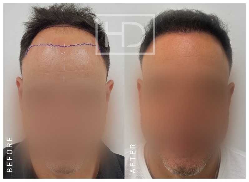 Nurse Hair Transplant