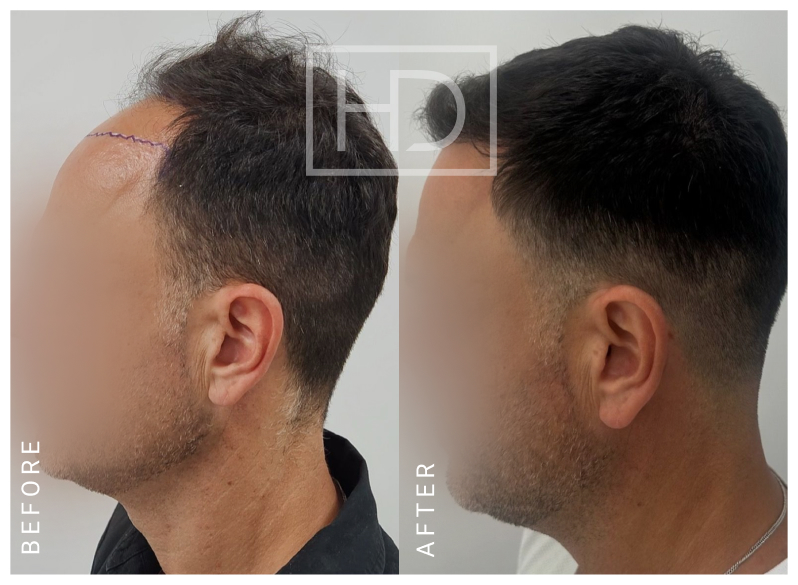 Nurse Hair Transplant