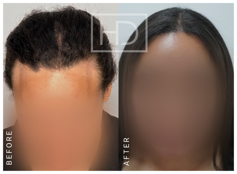 Nurse Hair Transplant