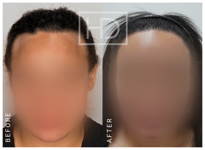 Nurse Hair Transplant