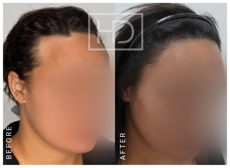 Nurse Hair Transplant