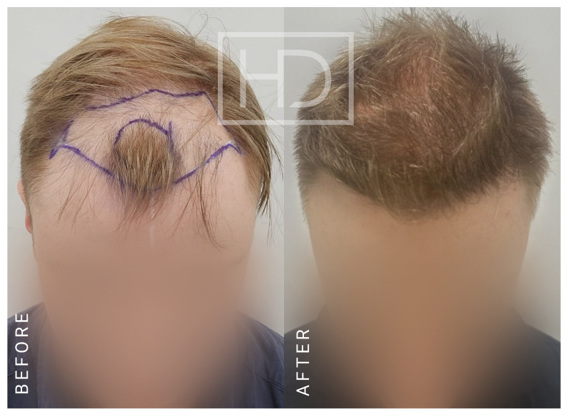 Nurse Hair Transplant