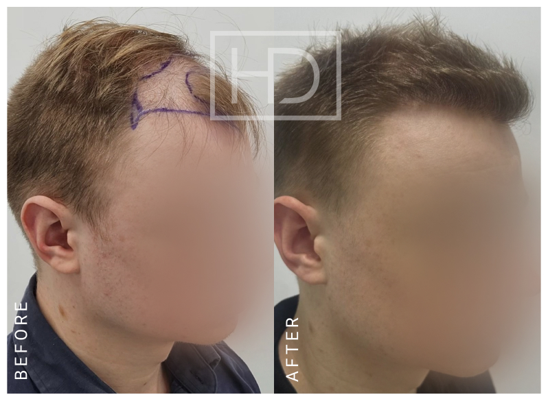 Nurse Hair Transplant
