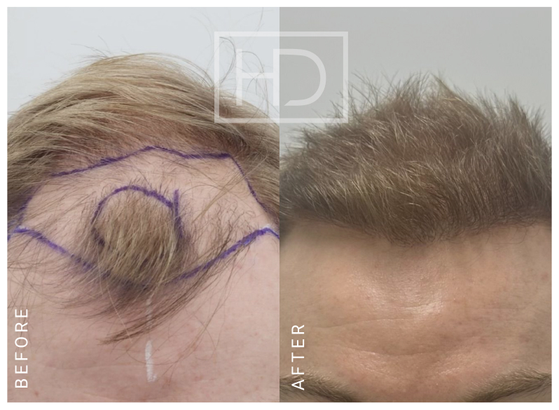 Nurse Hair Transplant