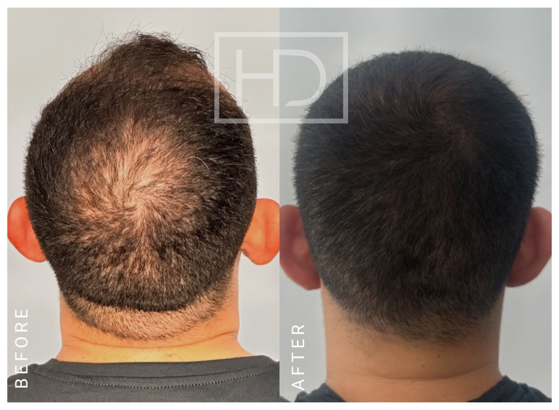 Nurse Hair Transplant