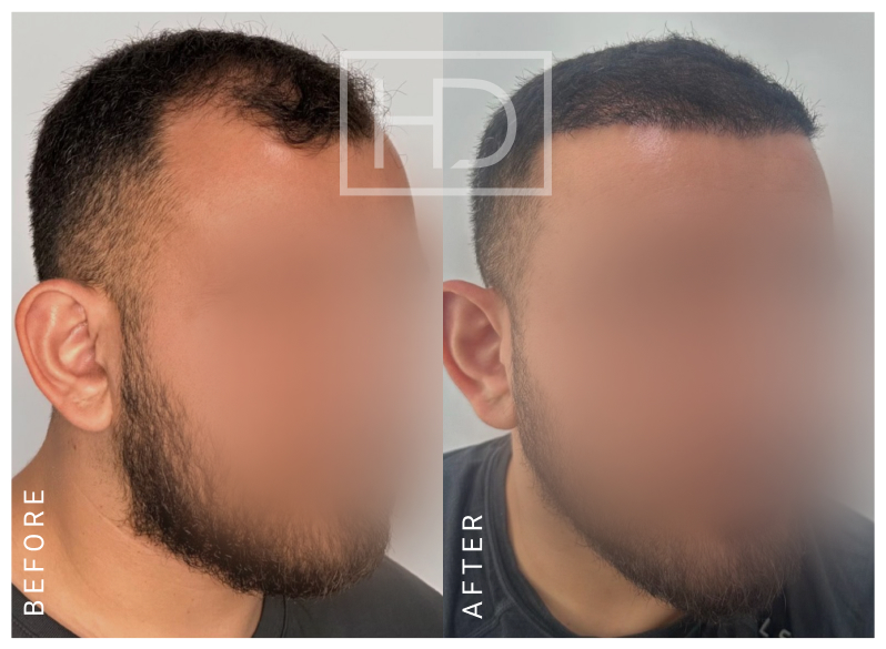 Nurse Hair Transplant