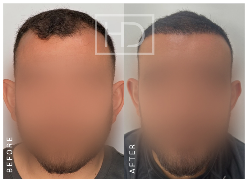Nurse Hair Transplant