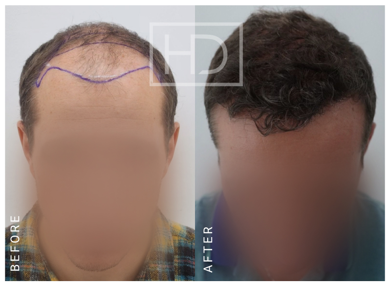 Nurse Hair Transplant