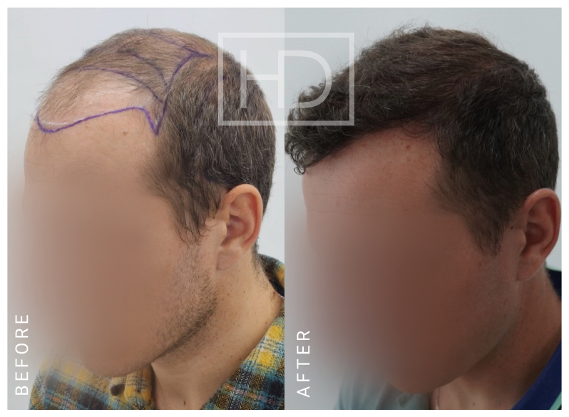 Nurse Hair Transplant