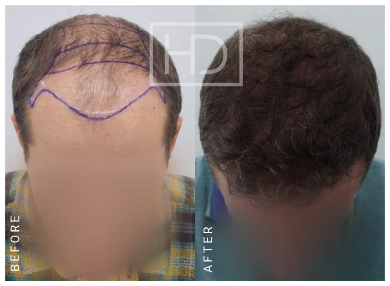 Nurse Hair Transplant