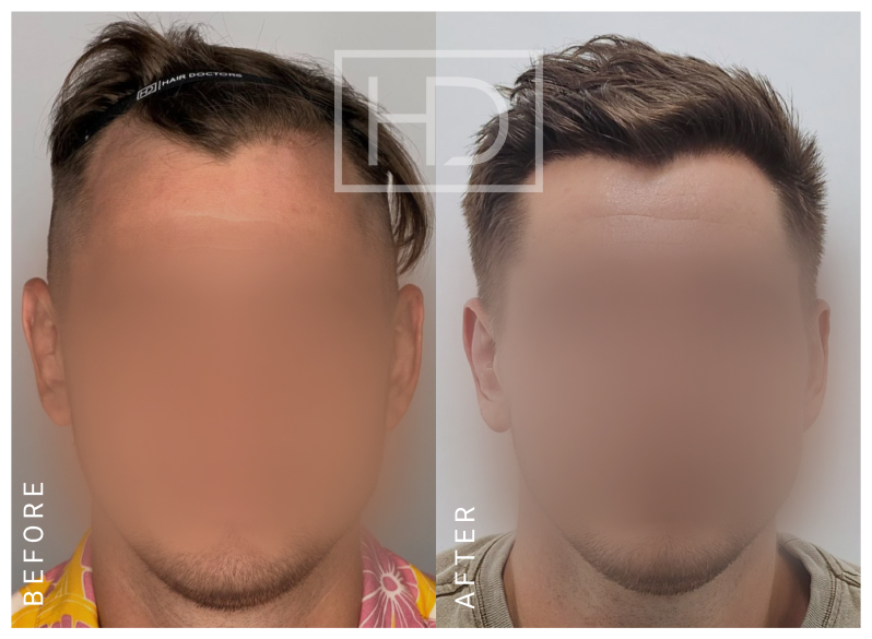 Nurse Hair Transplant