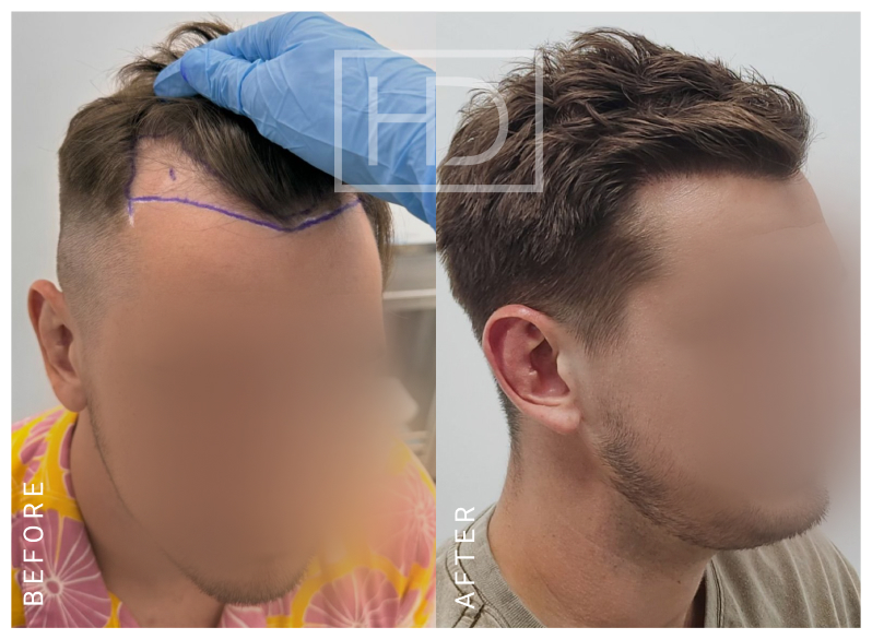 Nurse Hair Transplant