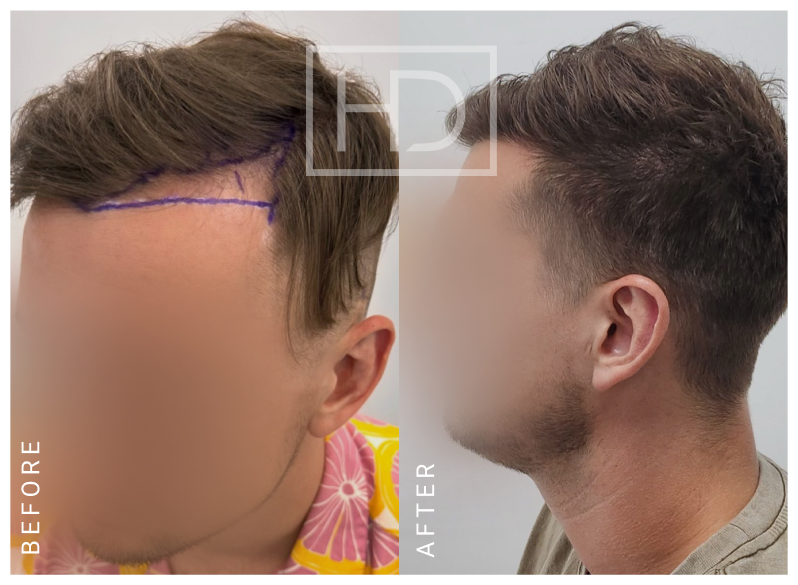 Nurse Hair Transplant