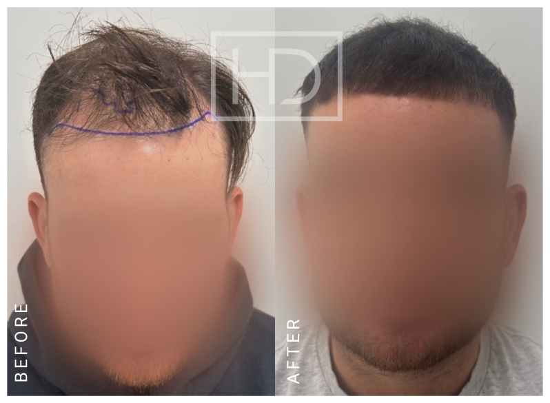 Nurse Hair Transplant