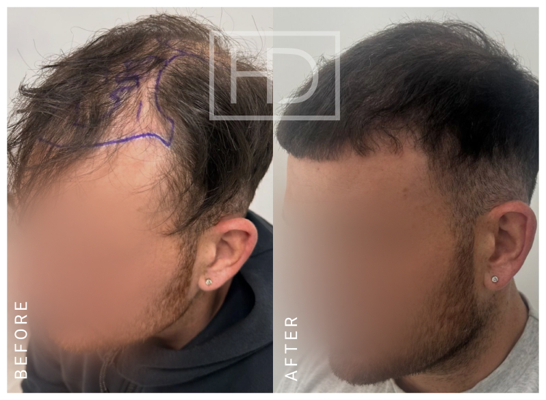 Nurse Hair Transplant