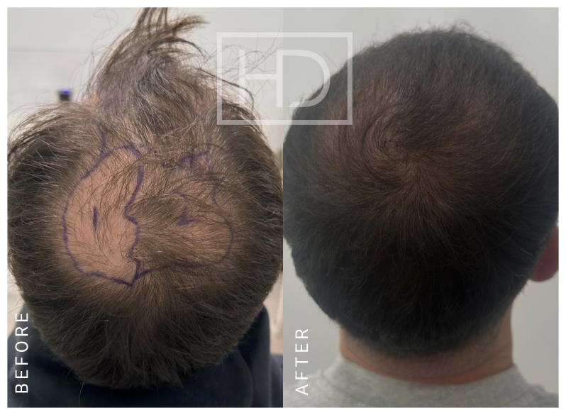 Nurse Hair Transplant